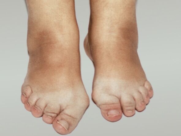 Arthrosis of the foot with severe deformation of the toes