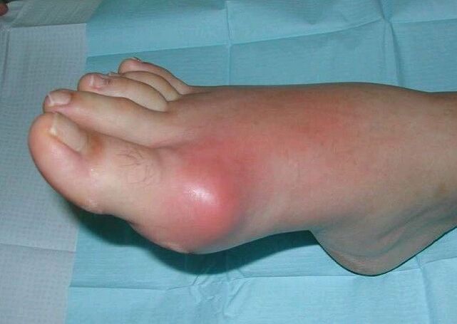 Clinical picture of foot arthritis swelling and inflammation