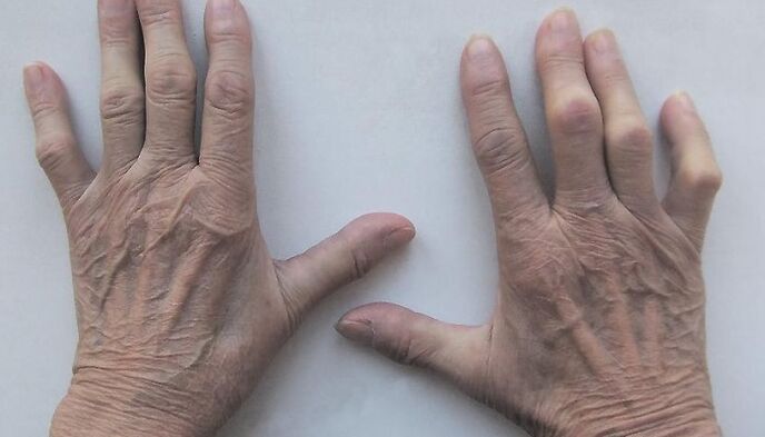 pain in the joints of the fingers
