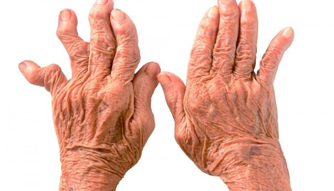 rheumatoid arthritis as a cause of finger joint pain