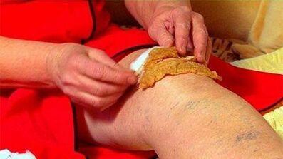 Compresses for the arthrosis of the knee joint