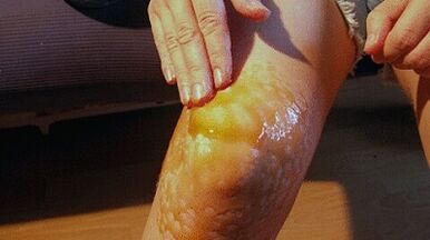 Rubs for the treatment of arthrosis of the knee joint