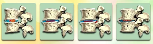 The stages of development of degenerative disc disease