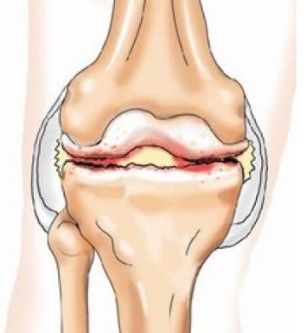 Vospaleniya the tendons of the knee