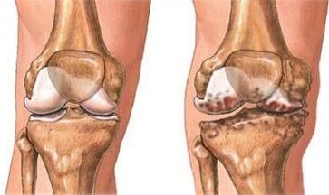 Osteoarthritis of the knee