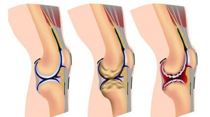Three degrees of gravity of the disease
