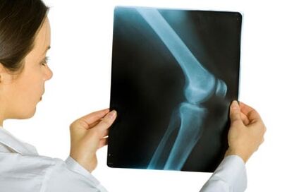 Treatment of arthrosis of the knee joint