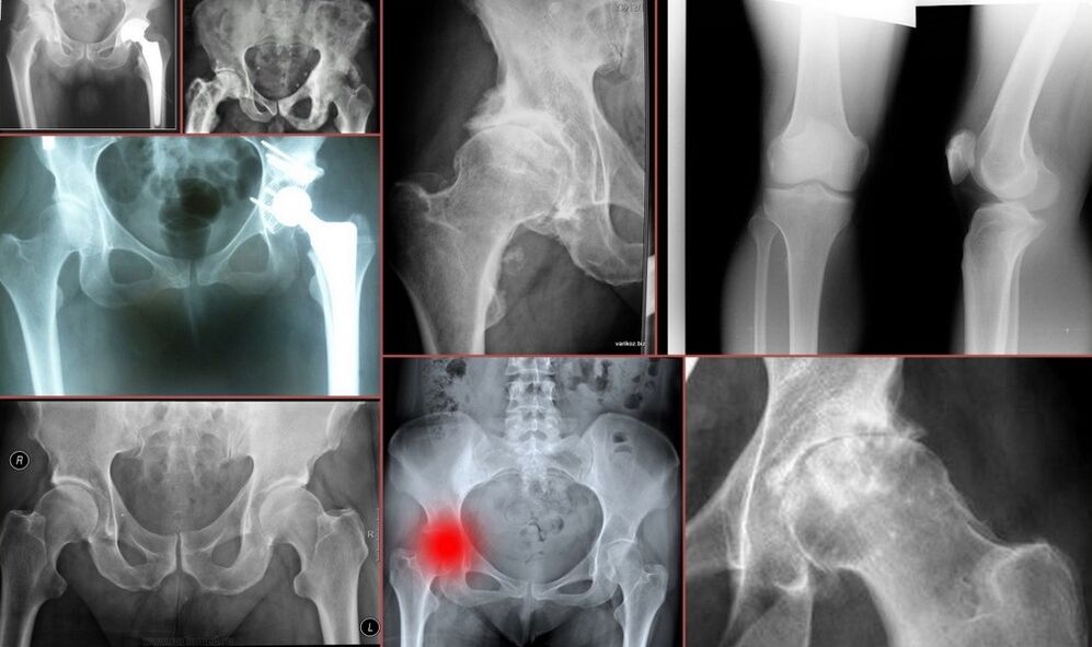 X-ray for hip pain