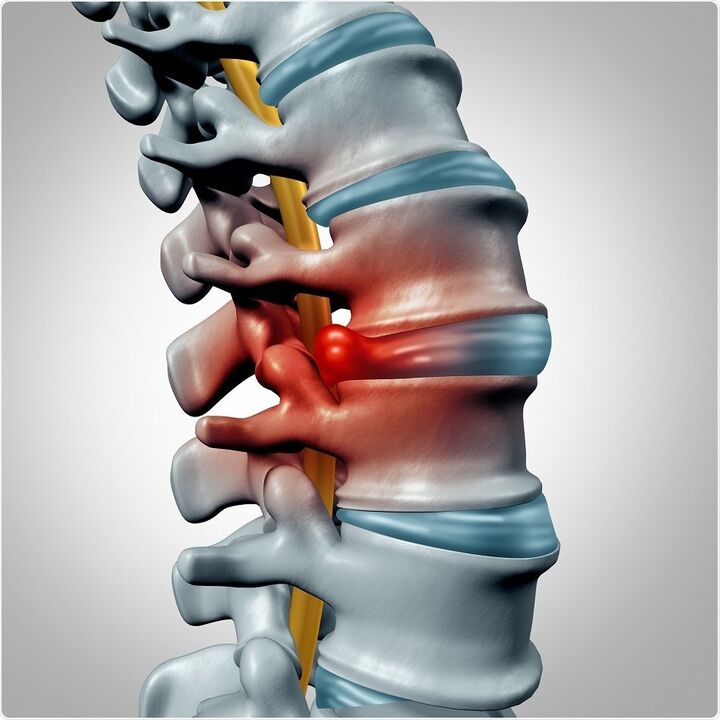 Deformation of the disc